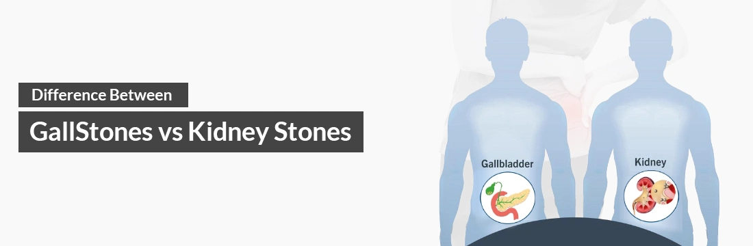  Difference Between Gall Stone vs Kidney Stone